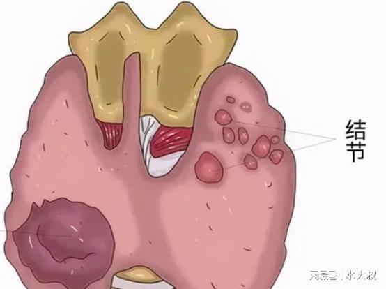 体检发现甲状腺结节？必看90%人群所需复查指南