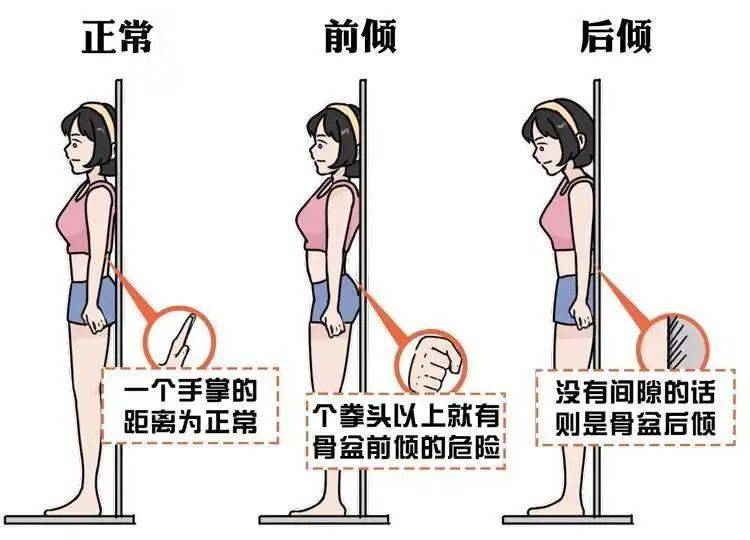 圆肩驼背与骨盆前倾肌力平衡训练全解析