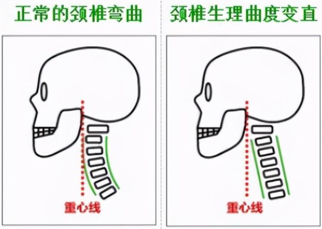 颈椎曲度变直可恢复？康复科医生详解科学训练方案